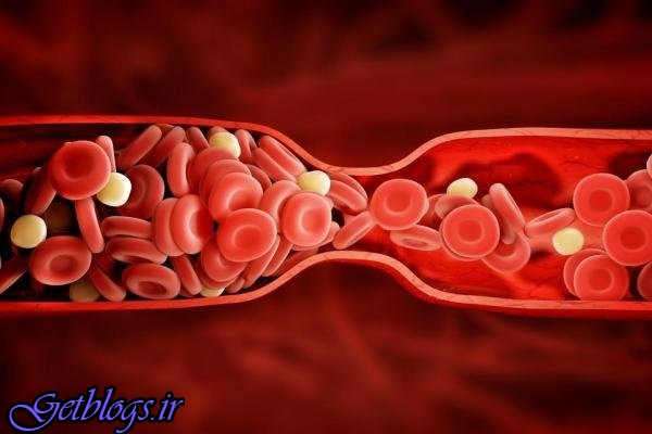 عوامل تاثیرگذار بر زیاد کردن خطر لخته شدن خون را بشناسید