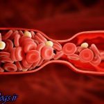 عوامل تاثیرگذار بر زیاد کردن خطر لخته شدن خون را بشناسید