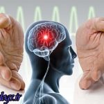 جوانان ایرانی ۷ برابر کشورهای دیگر سکته مغزی می کنند